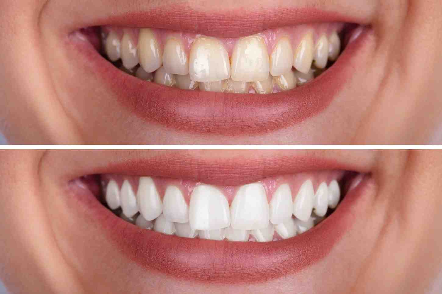 What Do Experts Recommend — Whitening Before or After Veneers Basildon