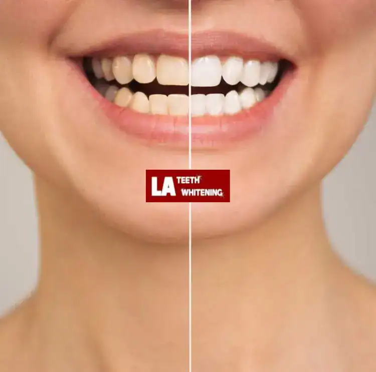1 Hour Teeth Whitening in Basildon Basildon