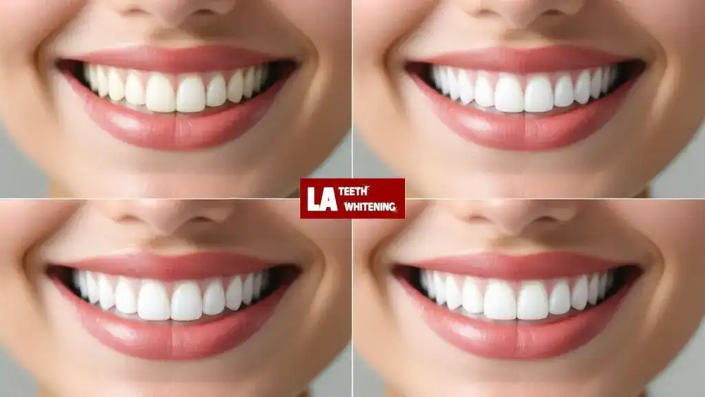Whitening Before or After Getting Veneers: What’s Best Basildon